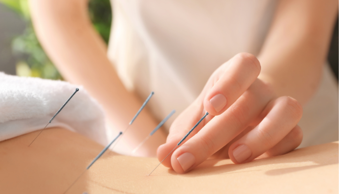 Acupuncture